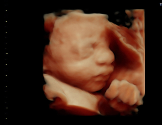 3D ultrasound image at 31 weeks